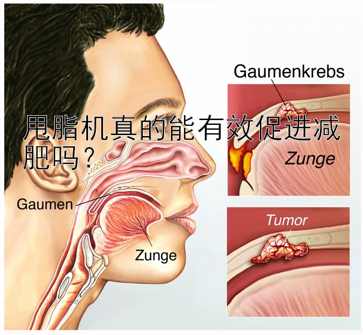 甩脂機(jī)真的能有效促進(jìn)減肥嗎？